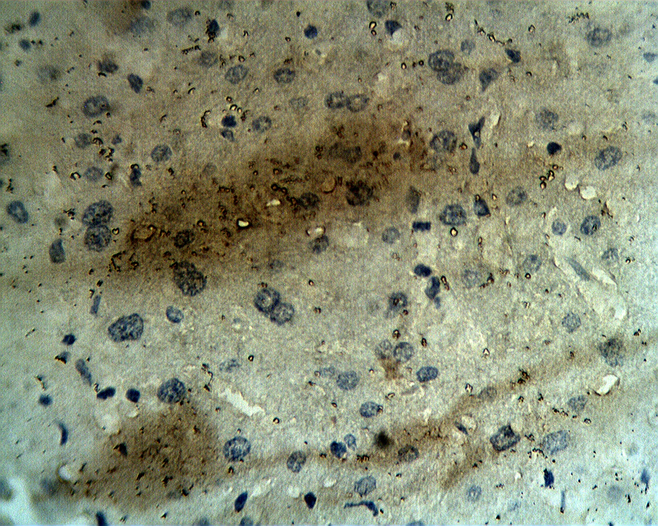 Staining on paraffin embedded human hepatocellular carcinoma sections. Primary Ab (immunoaffinity purified) at 10 µg/ml. Antigen retrieval used: 10 mM Na Citrate pH 6.0, 10 minutes pressure cooker method, developed with anti rabbit HRP and DAP substrate.  Counterstained with methyl blue.
